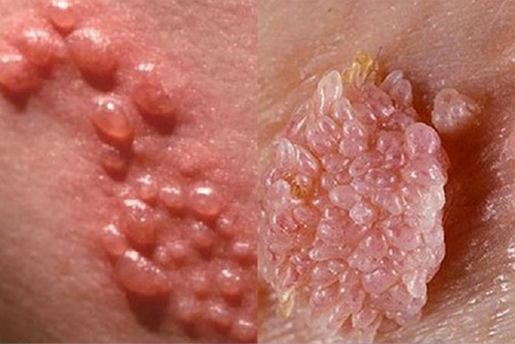Sùi mào gà là một trong những bệnh lây qua đường tình dục phổ biến